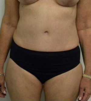 Tummy tuck (Abdominoplasty)