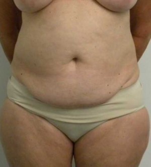 Tummy tuck (Abdominoplasty) Case 3864 Before Photo Tummy tuck (Abdominoplasty)