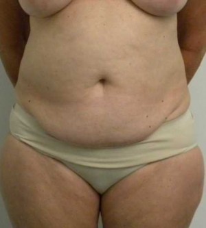 Tummy tuck (Abdominoplasty)