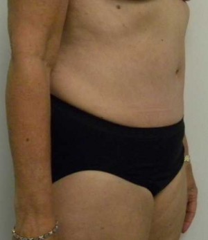 Tummy tuck (Abdominoplasty)