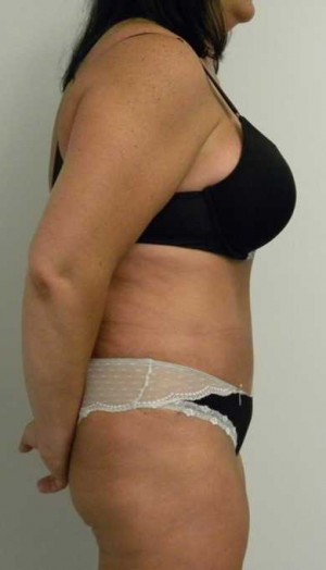 Tummy tuck (Abdominoplasty) Case 3871 After Photo Tummy tuck (Abdominoplasty)