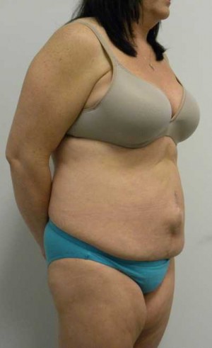 Tummy tuck (Abdominoplasty)