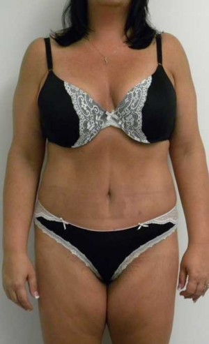 Tummy tuck (Abdominoplasty)