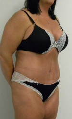 Tummy tuck (Abdominoplasty)