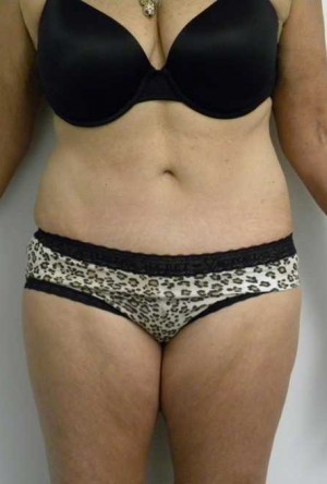 Tummy tuck (Abdominoplasty)