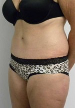 Tummy tuck (Abdominoplasty)