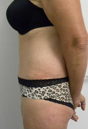 Tummy tuck (Abdominoplasty)