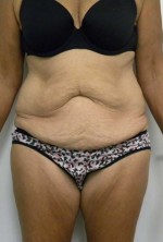 Tummy tuck (Abdominoplasty)