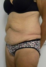 Tummy tuck (Abdominoplasty)