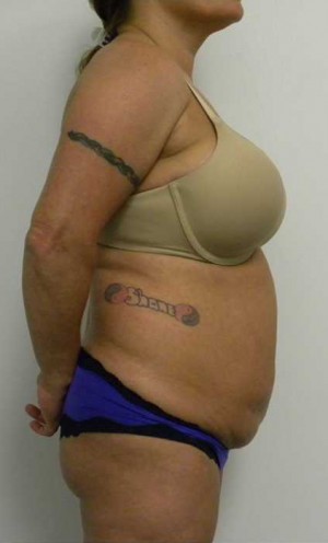 Tummy tuck (Abdominoplasty) Case 3885 Before Photo Tummy tuck (Abdominoplasty)