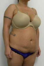 Tummy tuck (Abdominoplasty)