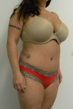 Tummy tuck (Abdominoplasty)