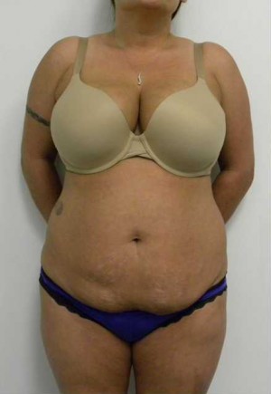 Tummy tuck (Abdominoplasty)