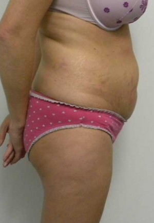 Tummy tuck (Abdominoplasty) Case 3892 Before Photo Tummy tuck (Abdominoplasty)