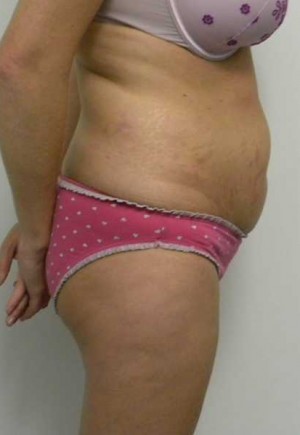 Tummy tuck (Abdominoplasty)