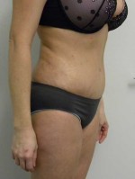 Tummy tuck (Abdominoplasty)