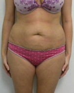 Tummy tuck (Abdominoplasty)