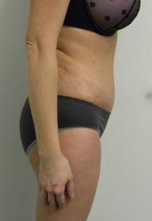 Tummy tuck (Abdominoplasty)