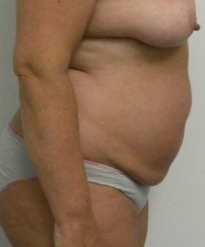 Tummy tuck (Abdominoplasty) Case 3899 Before Photo Tummy tuck (Abdominoplasty)