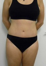 Tummy tuck (Abdominoplasty)
