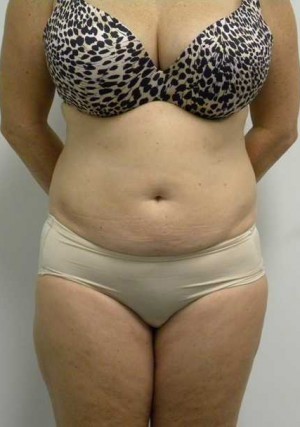 Tummy tuck (Abdominoplasty)