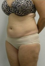 Tummy tuck (Abdominoplasty)