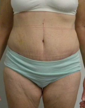 Tummy tuck (Abdominoplasty) Case 3913 After Photo Tummy tuck (Abdominoplasty)
