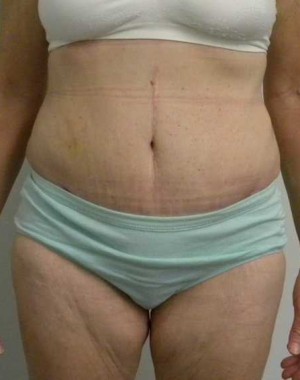 Tummy tuck (Abdominoplasty)