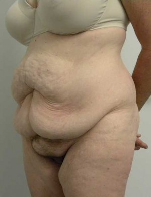 Tummy tuck (Abdominoplasty) Case 3913 Before Photo Tummy tuck (Abdominoplasty)