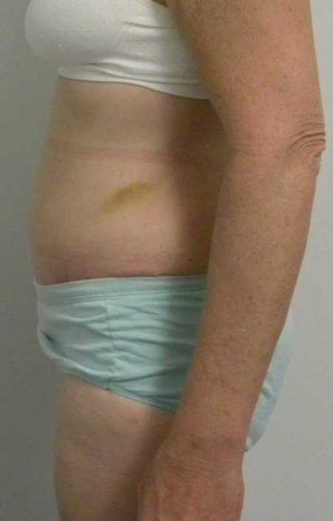 Tummy tuck (Abdominoplasty)