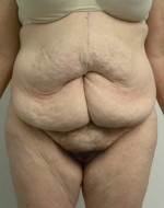 Tummy tuck (Abdominoplasty)