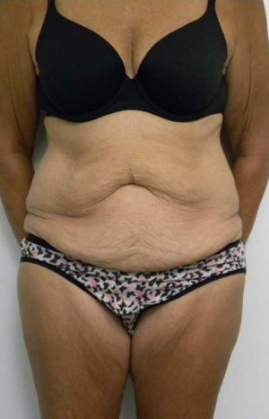 Tummy tuck (Abdominoplasty) Case 3920 Before Photo Tummy tuck (Abdominoplasty)