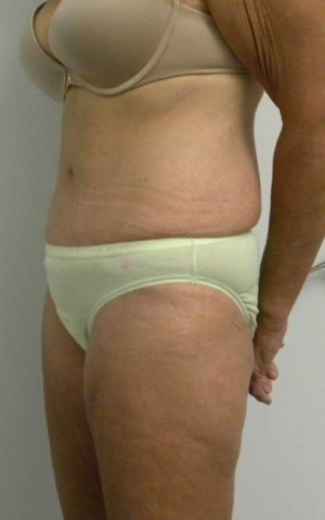 Tummy tuck (Abdominoplasty)