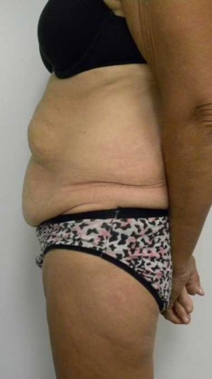 Tummy tuck (Abdominoplasty) Case 3920 Before Photo Tummy tuck (Abdominoplasty)