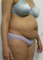 Tummy tuck (Abdominoplasty)