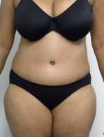 Tummy tuck (Abdominoplasty)