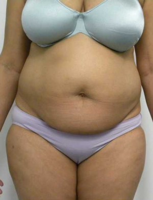 Tummy tuck (Abdominoplasty) Case 3934 Before Photo Tummy tuck (Abdominoplasty)