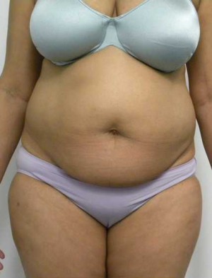 Tummy tuck (Abdominoplasty)