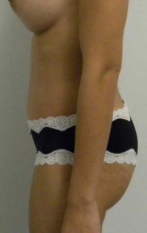 Tummy tuck (Abdominoplasty) Case 3941 After Photo Tummy tuck (Abdominoplasty)