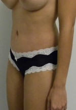 Tummy tuck (Abdominoplasty)