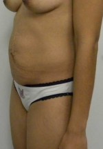 Tummy tuck (Abdominoplasty)