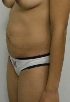 Tummy tuck (Abdominoplasty)
