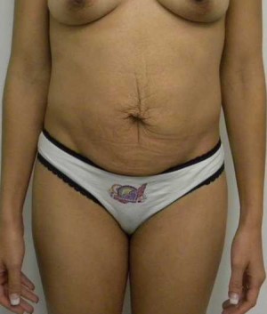 Tummy tuck (Abdominoplasty) Case 3941 Before Photo Tummy tuck (Abdominoplasty)