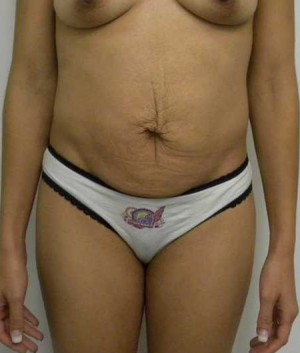 Tummy tuck (Abdominoplasty)