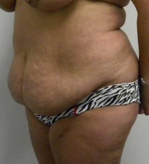 Tummy tuck (Abdominoplasty) Case 3948 Before Photo Tummy tuck (Abdominoplasty)