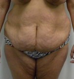 Tummy tuck (Abdominoplasty)