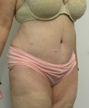 Tummy tuck (Abdominoplasty)