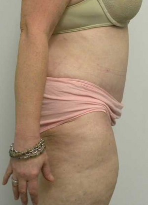 Tummy tuck (Abdominoplasty) Case 3955 After Photo Tummy tuck (Abdominoplasty)