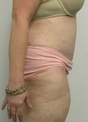 Tummy tuck (Abdominoplasty)