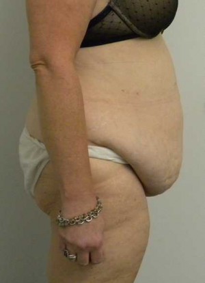 Tummy tuck (Abdominoplasty) Case 3955 Before Photo Tummy tuck (Abdominoplasty)